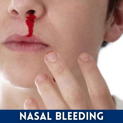 Nasal Bleeding