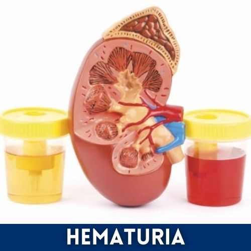 hematuria_