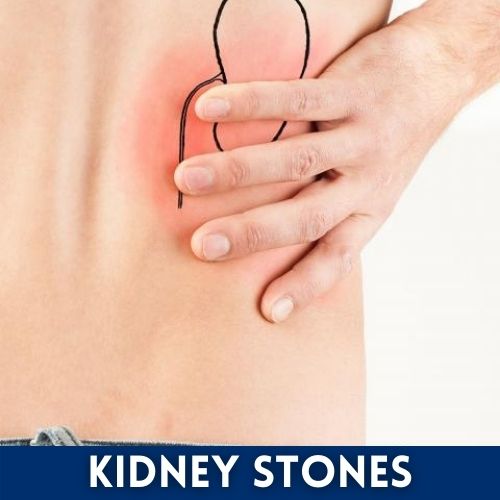 kidney-stones