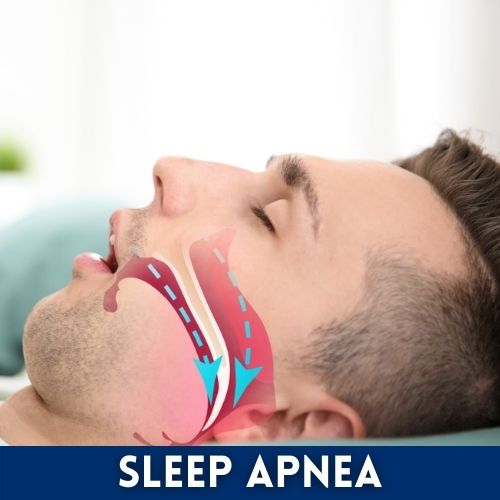 sleep apnea